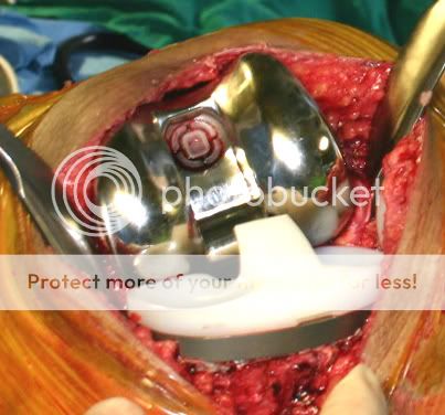 Image result for Pembedahan Knee Replacement